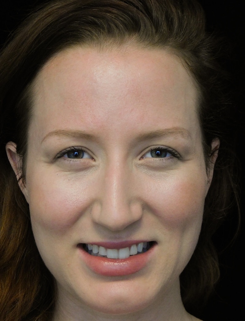 Beverly Hills Rhinoplasty Before & After Gallery - Patient 244673 - Image 5 Dr. Deepak Raj Dugar