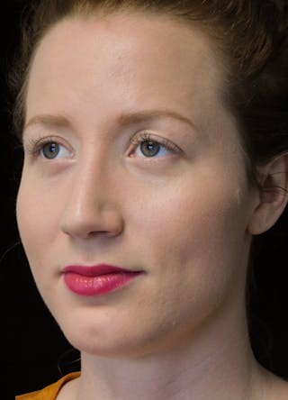 Beverly Hills Rhinoplasty Before & After Gallery - Patient 244673 - Image 8 Dr. Deepak Raj Dugar