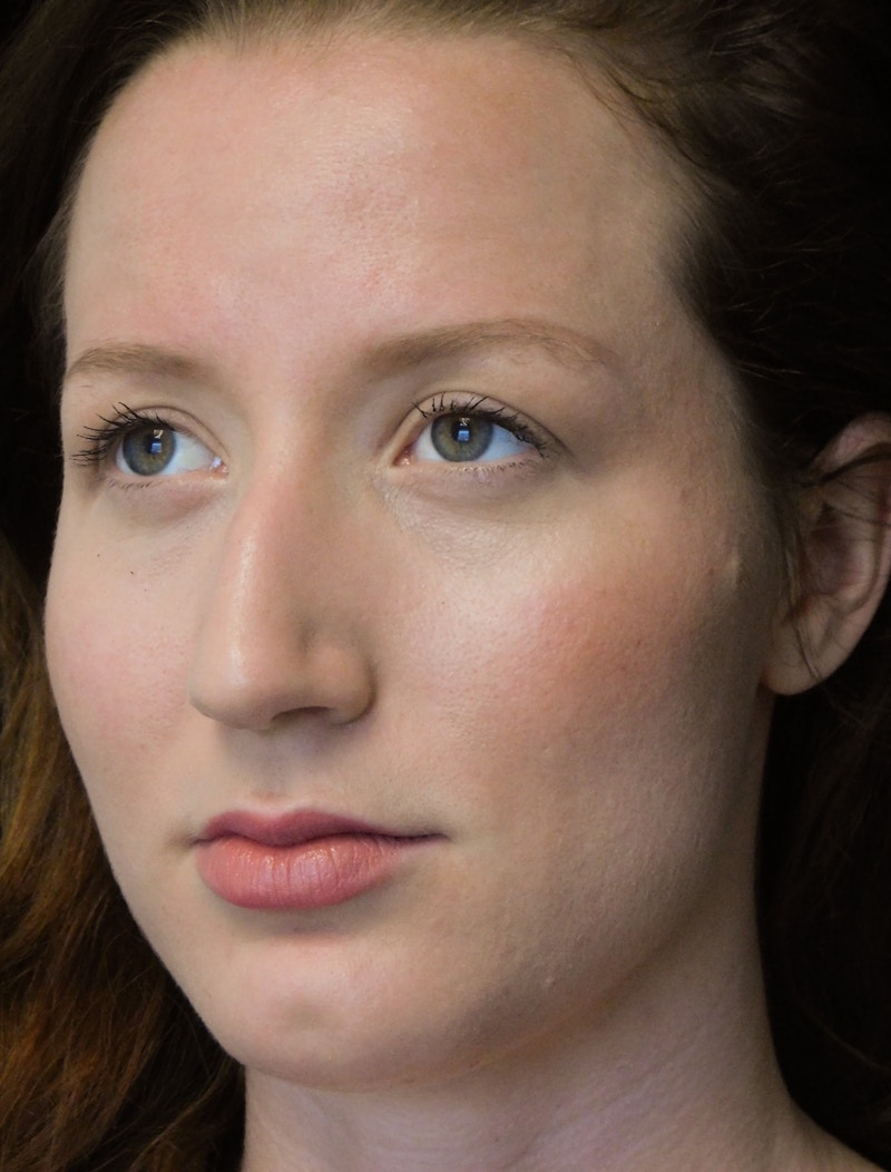 Beverly Hills Rhinoplasty Before & After Gallery - Patient 244673 - Image 7 Dr. Deepak Raj Dugar