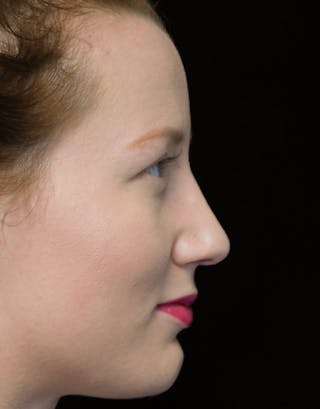 Beverly Hills Rhinoplasty Before & After Gallery - Patient 244673 - Image 2 Dr. Deepak Raj Dugar