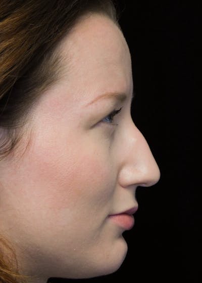 Beverly Hills Rhinoplasty Before & After Gallery - Patient 244673 - Image 1 Dr. Deepak Raj Dugar
