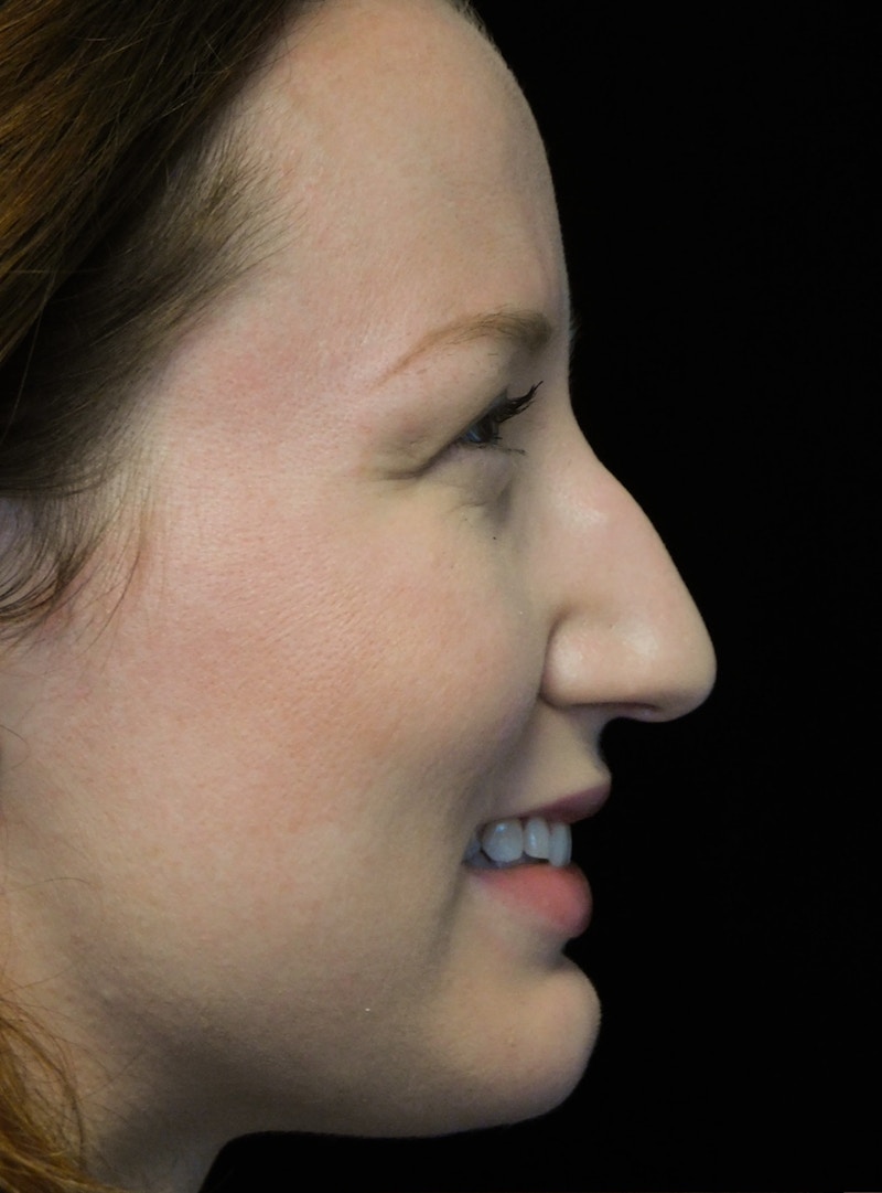 Beverly Hills Rhinoplasty Before & After Gallery - Patient 244673 - Image 9 Dr. Deepak Raj Dugar