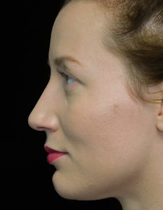 Beverly Hills Rhinoplasty Before & After Gallery - Patient 244673 - Image 12 Dr. Deepak Raj Dugar