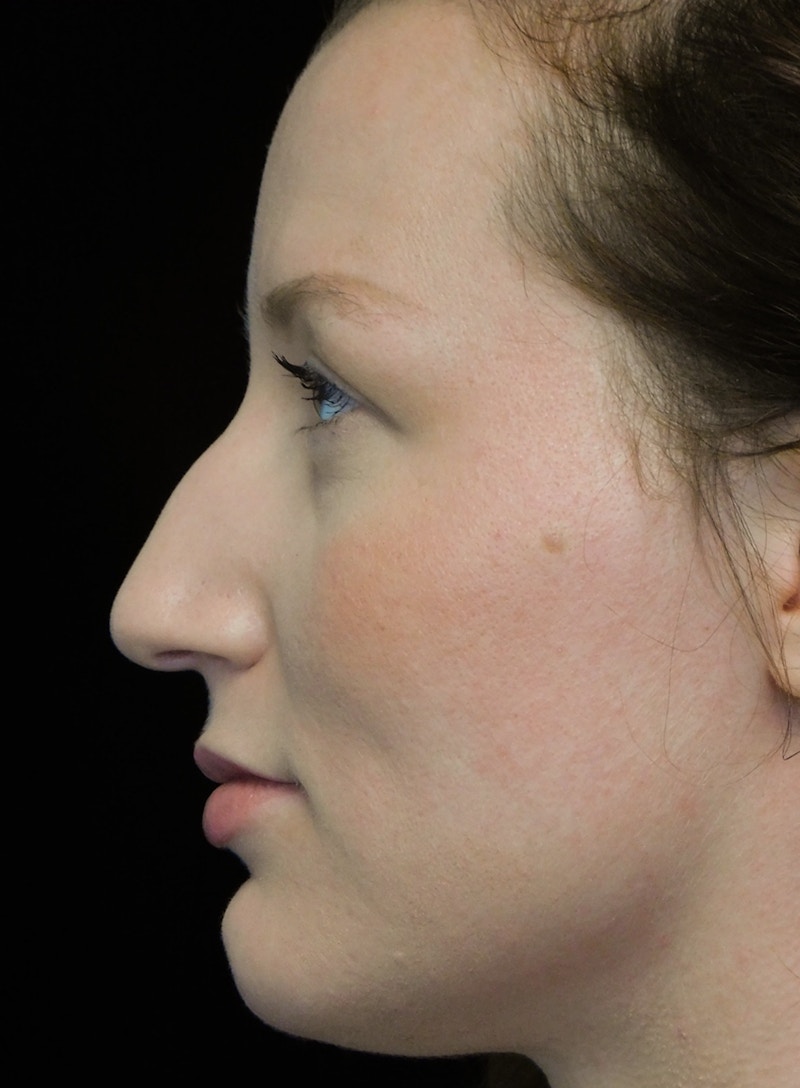 Beverly Hills Rhinoplasty Before & After Gallery - Patient 244673 - Image 11 Dr. Deepak Raj Dugar