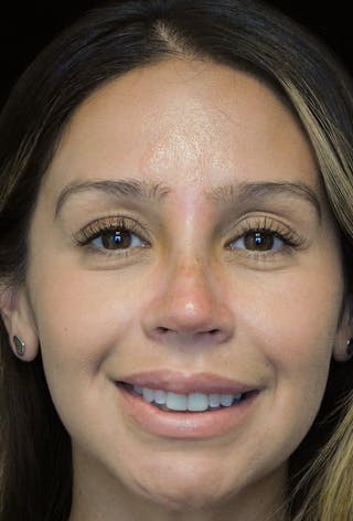 Beverly Hills Rhinoplasty Before & After Gallery - Patient 207629 - Image 4 Dr. Deepak Raj Dugar