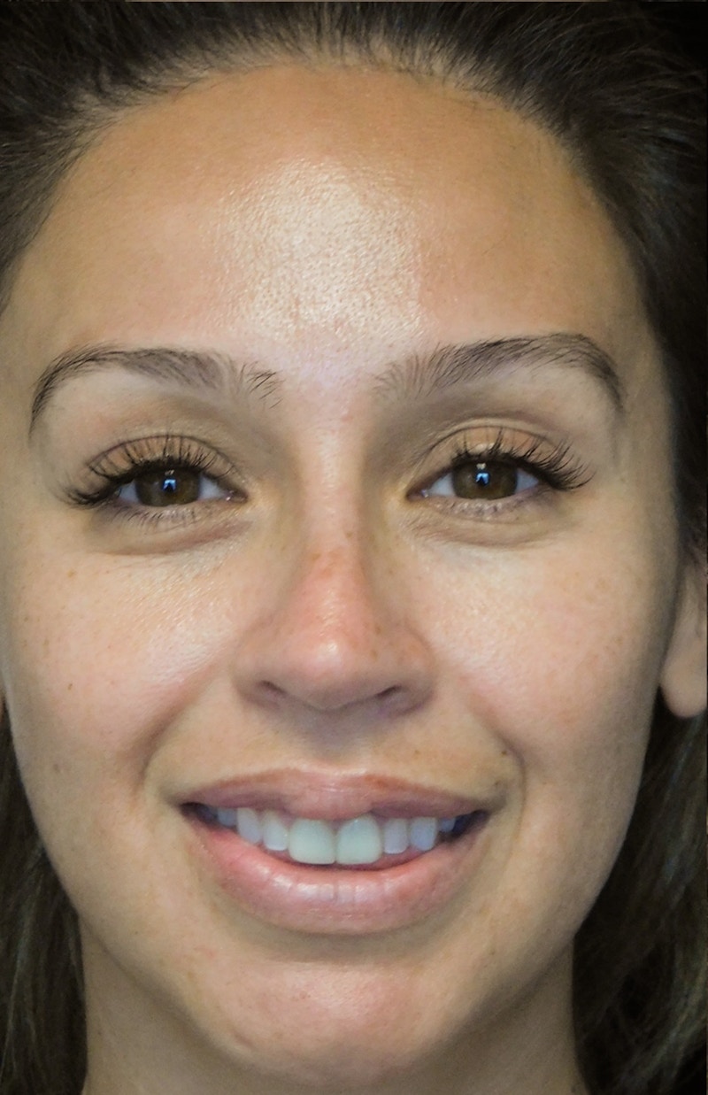 Beverly Hills Rhinoplasty Before & After Gallery - Patient 207629 - Image 3 Dr. Deepak Raj Dugar