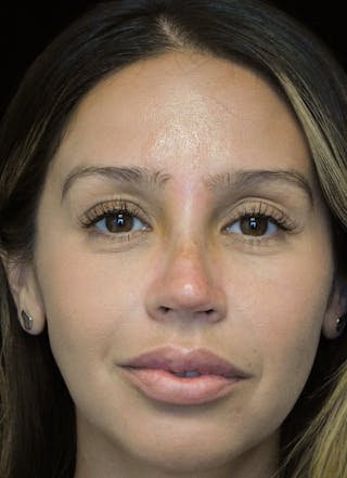 Beverly Hills Rhinoplasty Before & After Gallery - Patient 207629 - Image 6 Dr. Deepak Raj Dugar