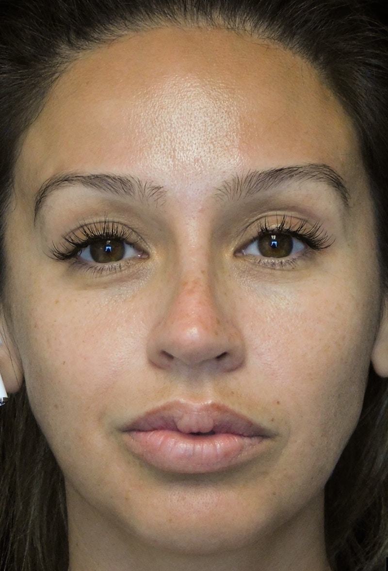 Beverly Hills Rhinoplasty Before & After Gallery - Patient 207629 - Image 5 Dr. Deepak Raj Dugar