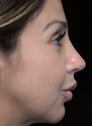 Beverly Hills Rhinoplasty Before & After Gallery - Patient 207629 - Image 2 Dr. Deepak Raj Dugar
