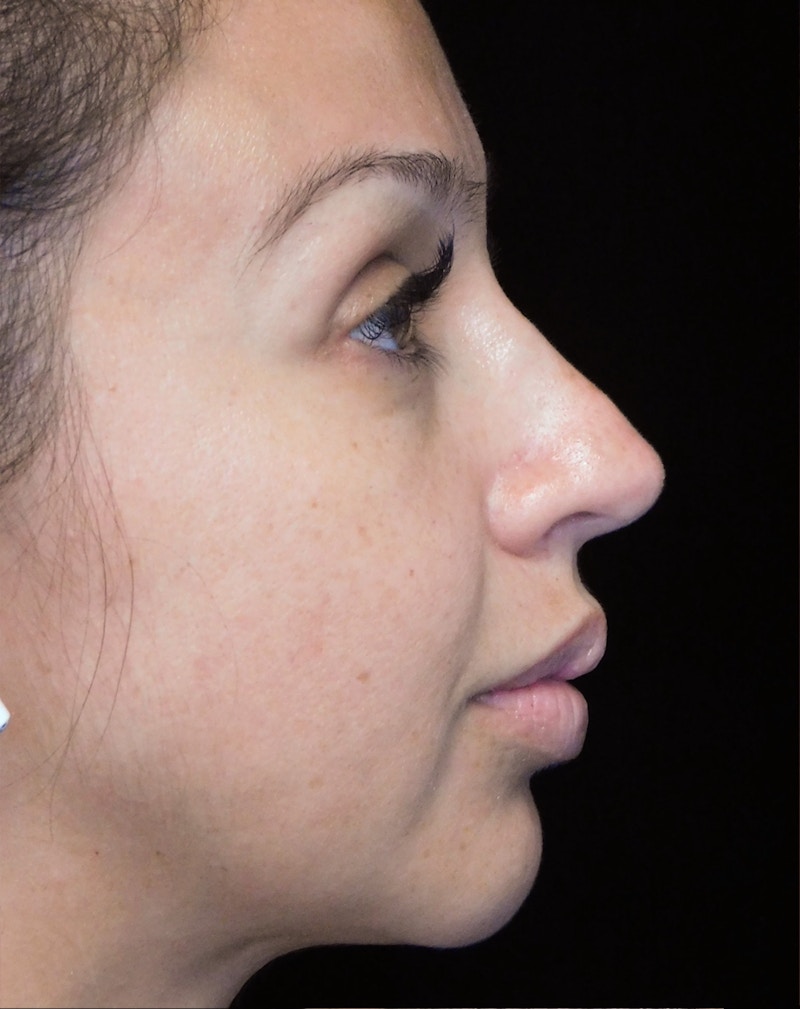Beverly Hills Rhinoplasty Before & After Gallery - Patient 207629 - Image 1 Dr. Deepak Raj Dugar