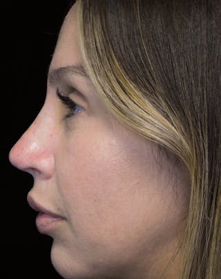 Beverly Hills Rhinoplasty Before & After Gallery - Patient 207629 - Image 10 Dr. Deepak Raj Dugar