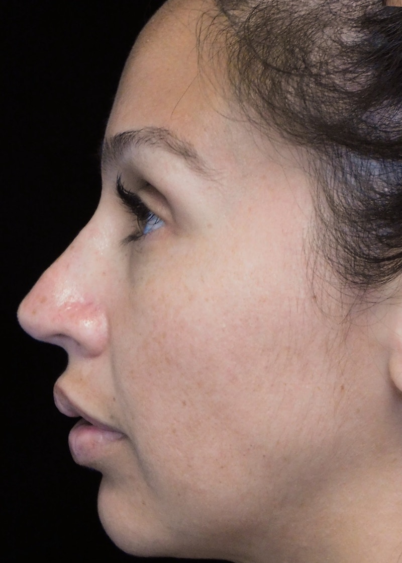 Beverly Hills Rhinoplasty Before & After Gallery - Patient 207629 - Image 9 Dr. Deepak Raj Dugar