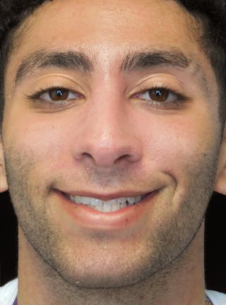 Beverly Hills Rhinoplasty Before & After Gallery - Patient 396775 - Image 4 Dr. Deepak Raj Dugar