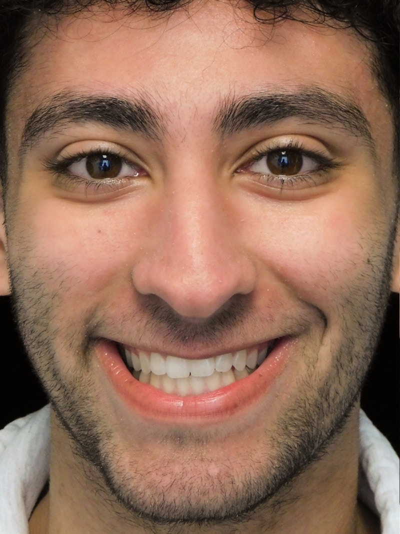 Beverly Hills Rhinoplasty Before & After Gallery - Patient 396775 - Image 3 Dr. Deepak Raj Dugar