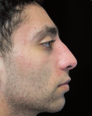 Beverly Hills Rhinoplasty Before & After Gallery - Patient 396775 - Image 2 Dr. Deepak Raj Dugar