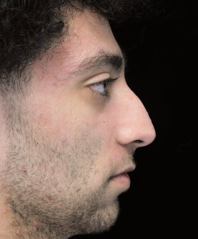 Beverly Hills Rhinoplasty Before & After Gallery - Patient 396775 - Image 1 Dr. Deepak Raj Dugar