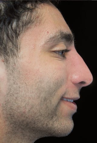 Beverly Hills Rhinoplasty Before & After Gallery - Patient 396775 - Image 6 Dr. Deepak Raj Dugar