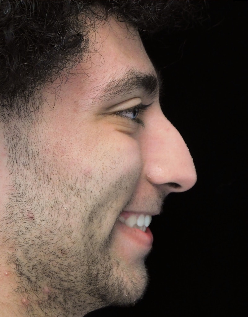 Beverly Hills Rhinoplasty Before & After Gallery - Patient 396775 - Image 5 Dr. Deepak Raj Dugar