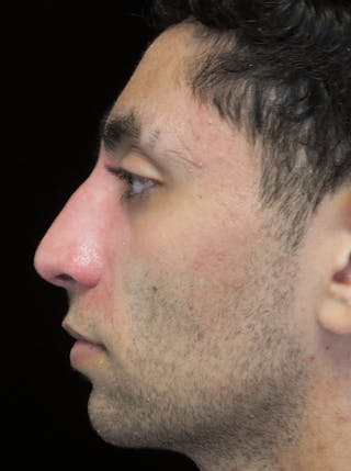 Beverly Hills Rhinoplasty Before & After Gallery - Patient 396775 - Image 8 Dr. Deepak Raj Dugar