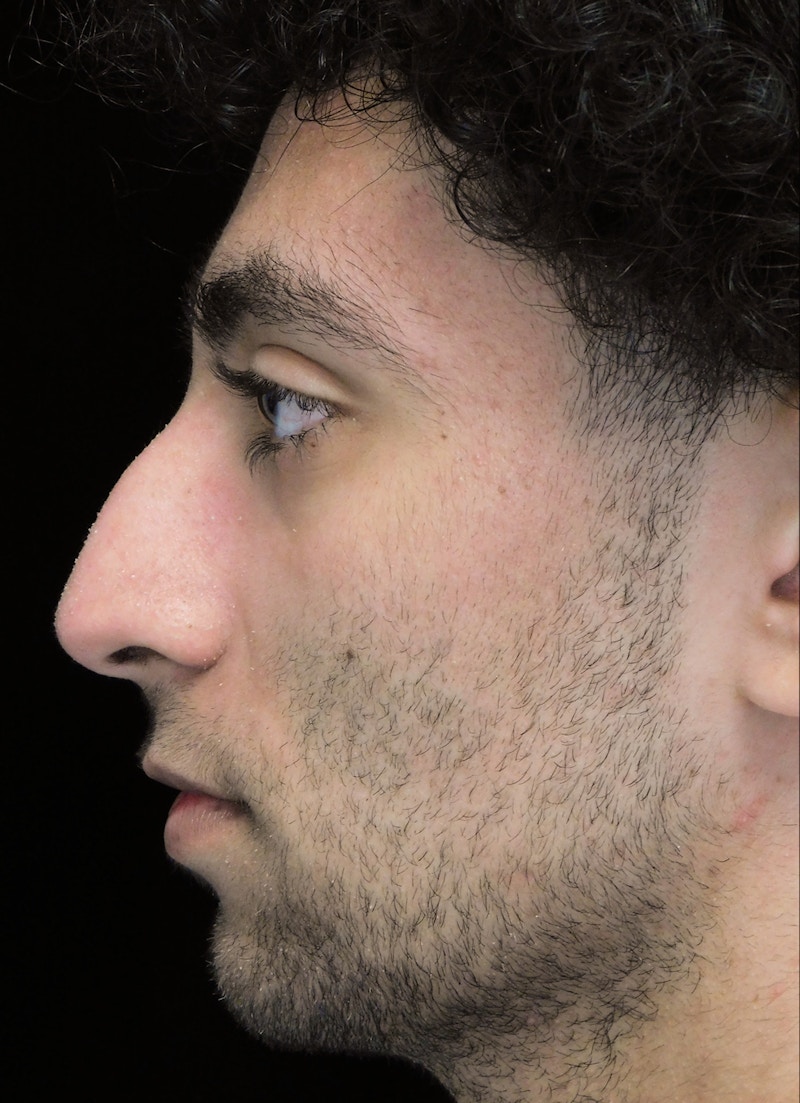 Beverly Hills Rhinoplasty Before & After Gallery - Patient 396775 - Image 7 Dr. Deepak Raj Dugar