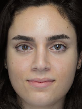 Beverly Hills Rhinoplasty Before & After Gallery - Patient 162247 - Image 4 Dr. Deepak Raj Dugar