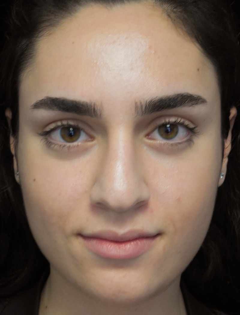 Beverly Hills Rhinoplasty Before & After Gallery - Patient 162247 - Image 3 Dr. Deepak Raj Dugar
