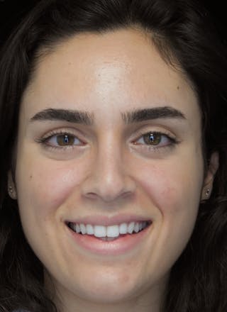 Beverly Hills Rhinoplasty Before & After Gallery - Patient 162247 - Image 6 Dr. Deepak Raj Dugar