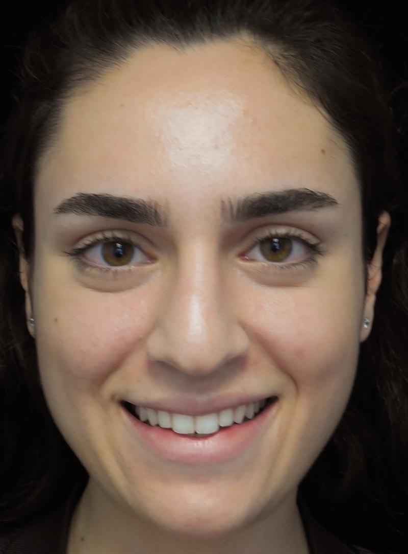 Beverly Hills Rhinoplasty Before & After Gallery - Patient 162247 - Image 5 Dr. Deepak Raj Dugar