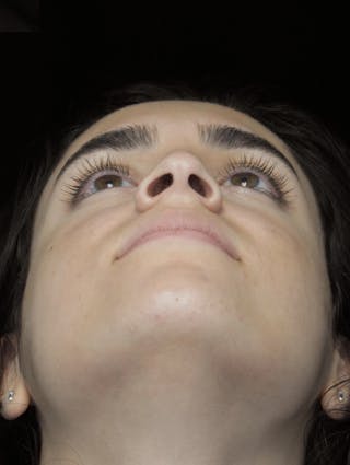 Beverly Hills Rhinoplasty Before & After Gallery - Patient 162247 - Image 8 Dr. Deepak Raj Dugar