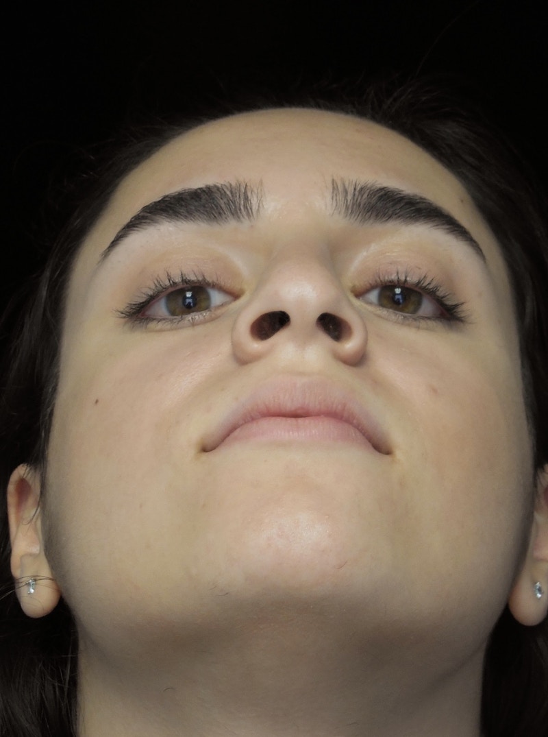Beverly Hills Rhinoplasty Before & After Gallery - Patient 162247 - Image 7 Dr. Deepak Raj Dugar