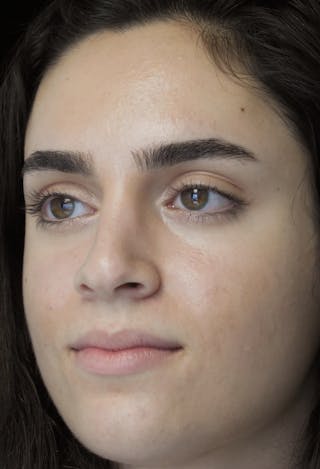 Beverly Hills Rhinoplasty Before & After Gallery - Patient 162247 - Image 10 Dr. Deepak Raj Dugar