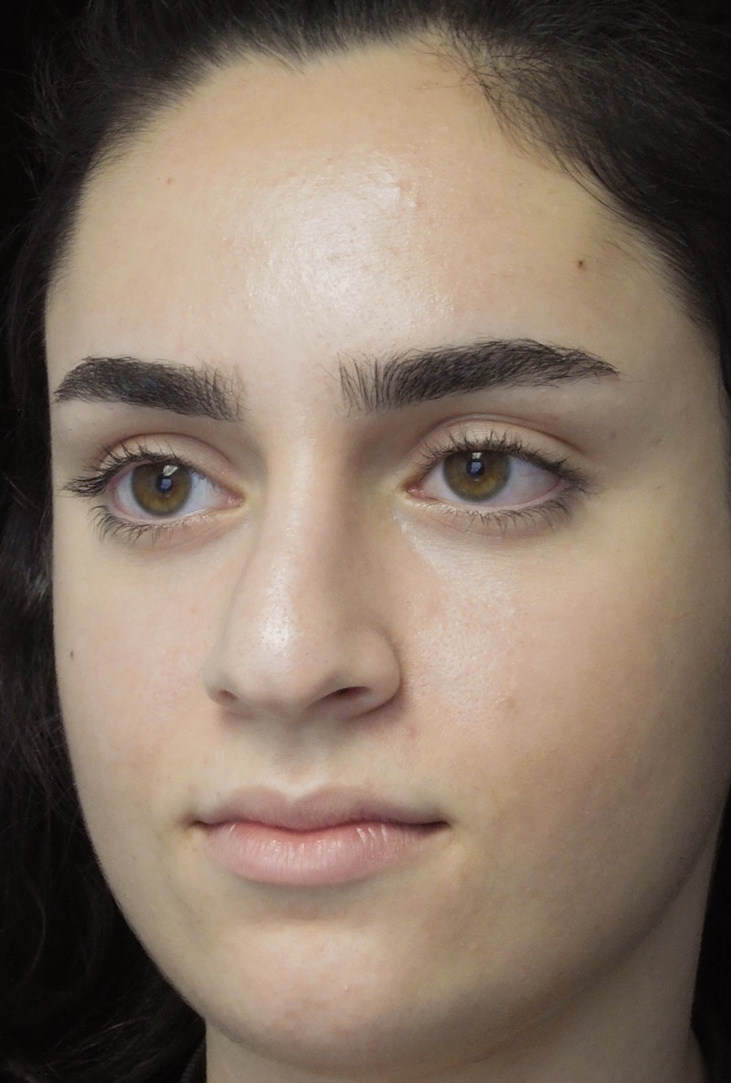 Beverly Hills Rhinoplasty Before & After Gallery - Patient 162247 - Image 9 Dr. Deepak Raj Dugar