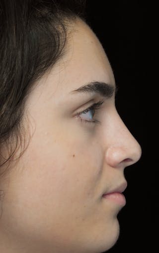 Beverly Hills Rhinoplasty Before & After Gallery - Patient 162247 - Image 2 Dr. Deepak Raj Dugar