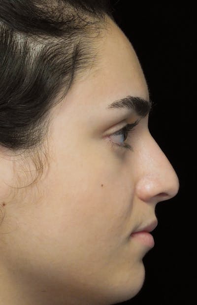 Beverly Hills Rhinoplasty Before & After Gallery - Patient 162247 - Image 1 Dr. Deepak Raj Dugar