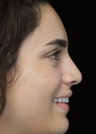 Beverly Hills Rhinoplasty Before & After Gallery - Patient 162247 - Image 12 Dr. Deepak Raj Dugar