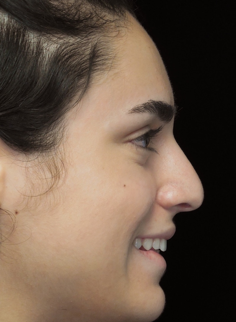 Beverly Hills Rhinoplasty Before & After Gallery - Patient 162247 - Image 11 Dr. Deepak Raj Dugar