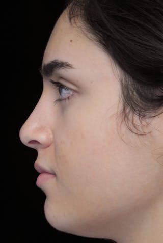 Beverly Hills Rhinoplasty Before & After Gallery - Patient 162247 - Image 14 Dr. Deepak Raj Dugar