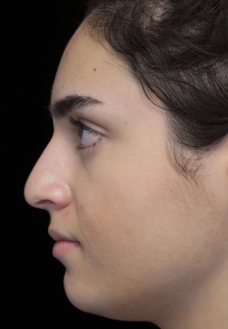 Beverly Hills Rhinoplasty Before & After Gallery - Patient 162247 - Image 13 Dr. Deepak Raj Dugar