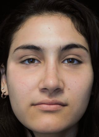 Beverly Hills Rhinoplasty Before & After Gallery - Patient 242623 - Image 4 Dr. Deepak Raj Dugar