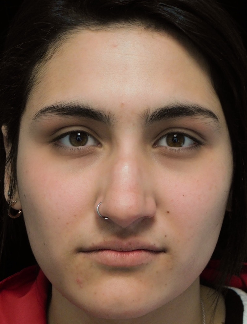 Beverly Hills Rhinoplasty Before & After Gallery - Patient 242623 - Image 3 Dr. Deepak Raj Dugar