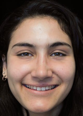 Beverly Hills Rhinoplasty Before & After Gallery - Patient 242623 - Image 6 Dr. Deepak Raj Dugar