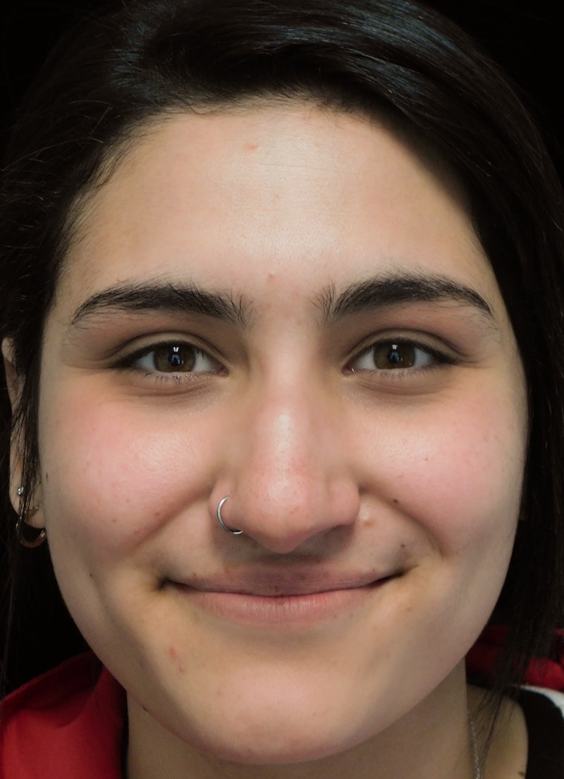Beverly Hills Rhinoplasty Before & After Gallery - Patient 242623 - Image 5 Dr. Deepak Raj Dugar