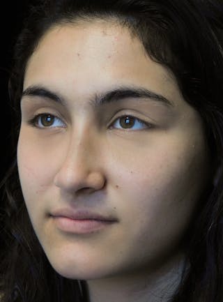 Beverly Hills Rhinoplasty Before & After Gallery - Patient 242623 - Image 8 Dr. Deepak Raj Dugar