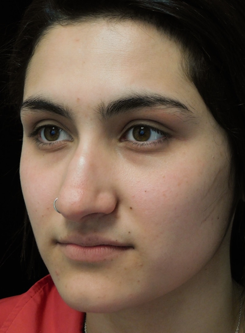 Beverly Hills Rhinoplasty Before & After Gallery - Patient 242623 - Image 7 Dr. Deepak Raj Dugar