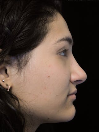 Beverly Hills Rhinoplasty Before & After Gallery - Patient 242623 - Image 2 Dr. Deepak Raj Dugar