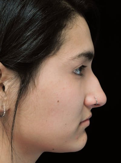 Beverly Hills Rhinoplasty Before & After Gallery - Patient 242623 - Image 1 Dr. Deepak Raj Dugar