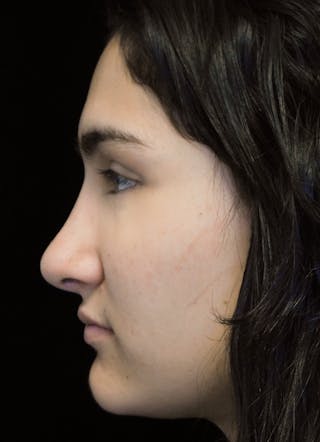 Beverly Hills Rhinoplasty Before & After Gallery - Patient 242623 - Image 10 Dr. Deepak Raj Dugar
