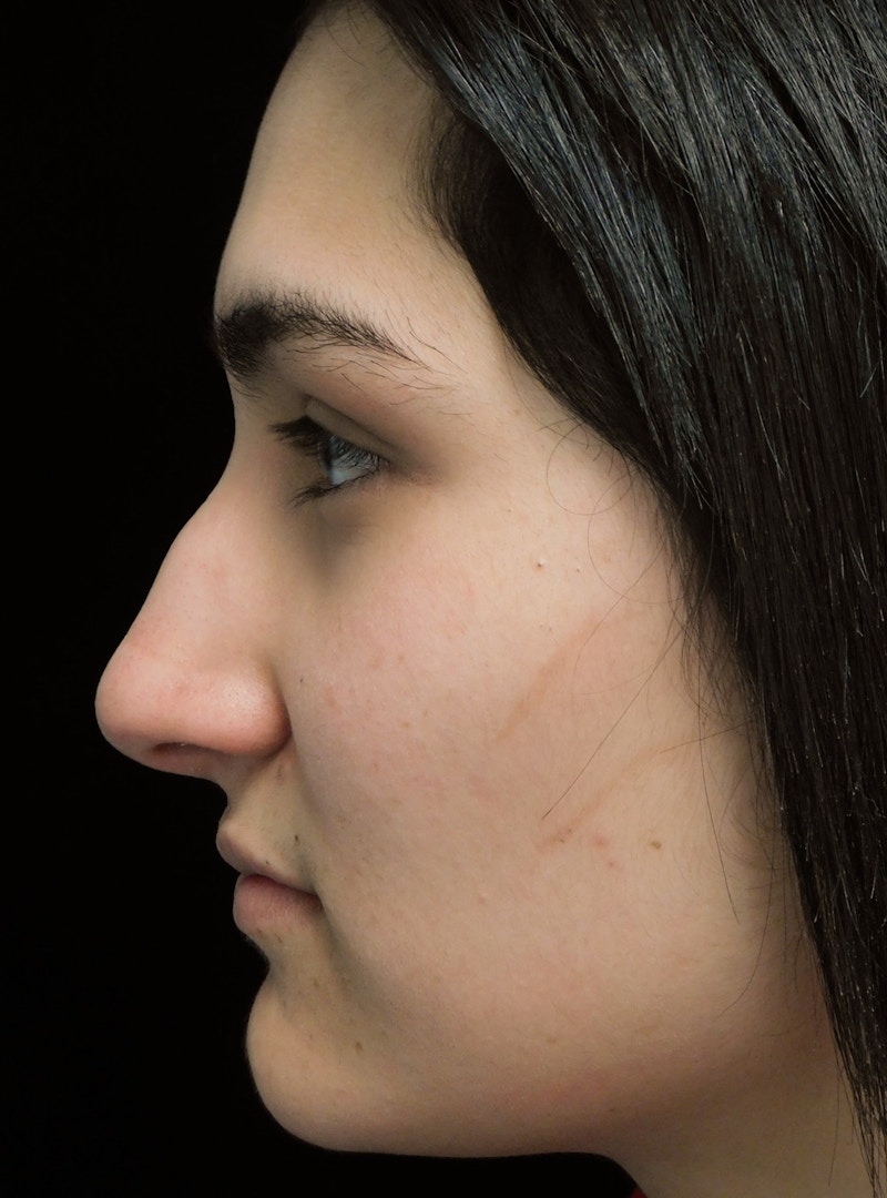 Beverly Hills Rhinoplasty Before & After Gallery - Patient 242623 - Image 9 Dr. Deepak Raj Dugar