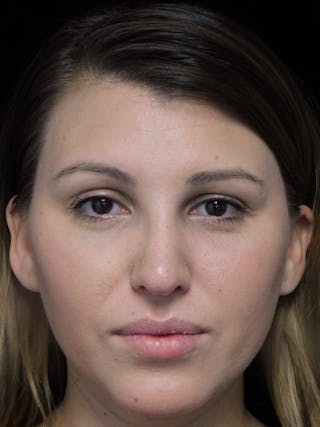 Beverly Hills Rhinoplasty Before & After Gallery - Patient 244001 - Image 4 Dr. Deepak Raj Dugar