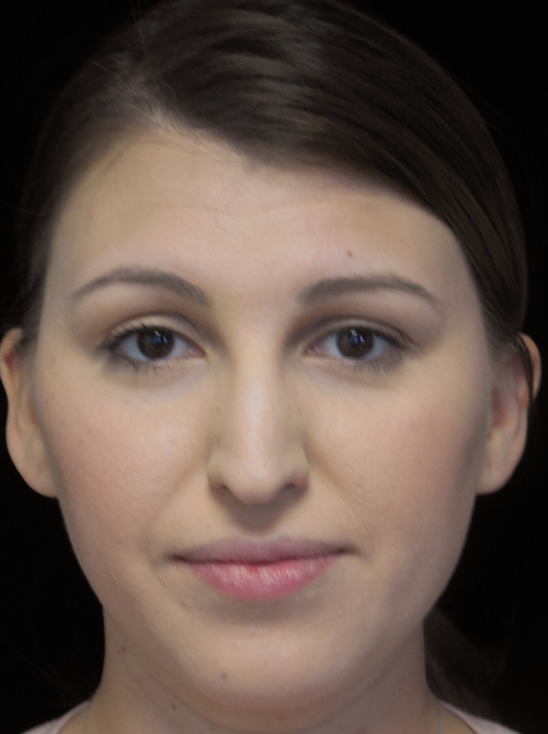 Beverly Hills Rhinoplasty Before & After Gallery - Patient 244001 - Image 3 Dr. Deepak Raj Dugar